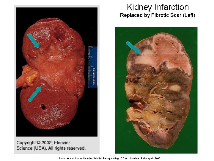 Kidney Infarction Replaced by Fibrotic Scar (Left) Photo: Kumar, Cotran, Robbins Basic pathology, 7