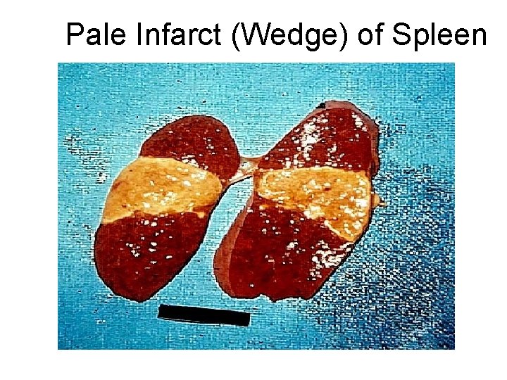 Pale Infarct (Wedge) of Spleen 