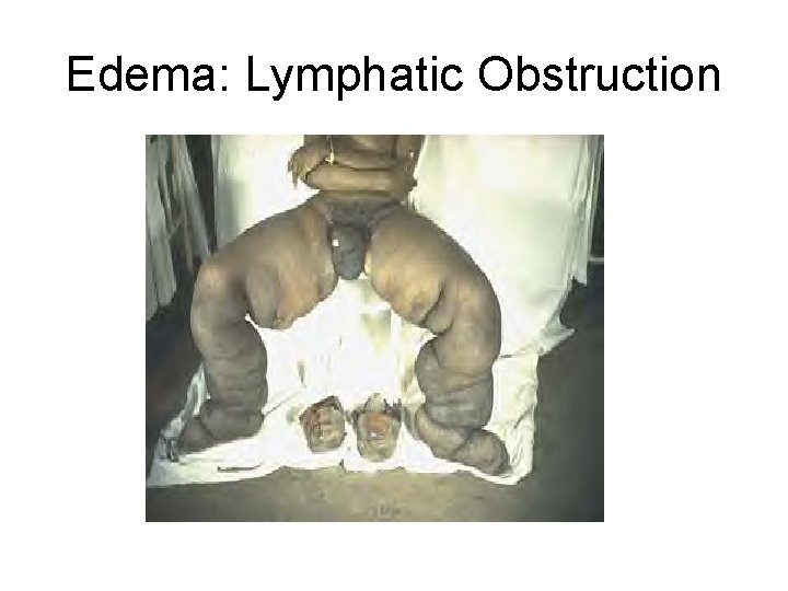 Edema: Lymphatic Obstruction 