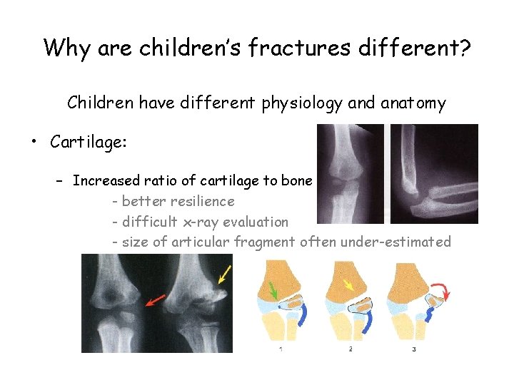 Why are children’s fractures different? Children have different physiology and anatomy • Cartilage: –