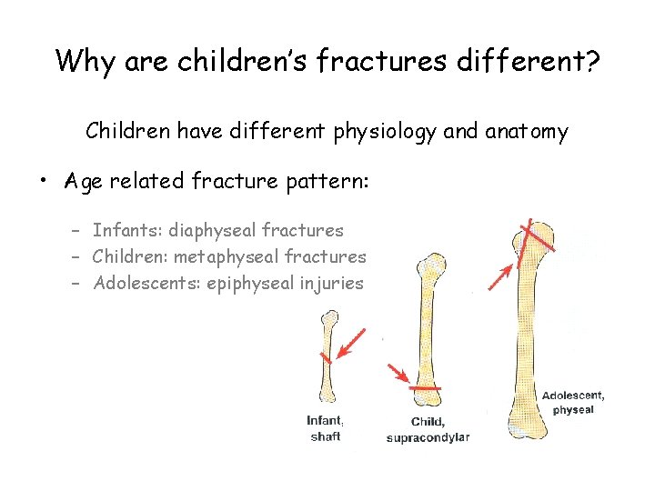 Why are children’s fractures different? Children have different physiology and anatomy • Age related
