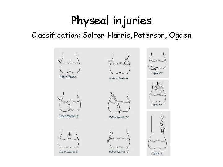 Physeal injuries Classification: Salter-Harris, Peterson, Ogden 