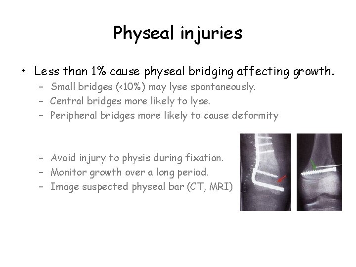 Physeal injuries • Less than 1% cause physeal bridging affecting growth. – Small bridges