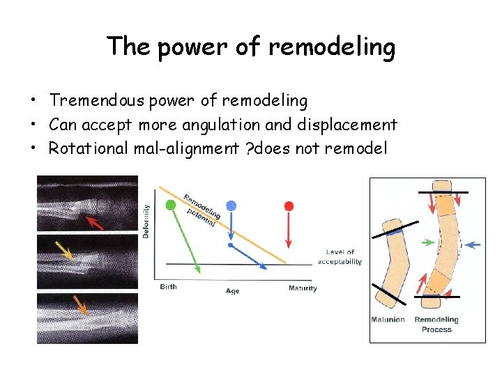 The power of remodeling • Tremendous power of remodeling • Can accept more angulation