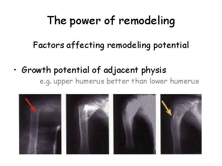 The power of remodeling Factors affecting remodeling potential • Growth potential of adjacent physis