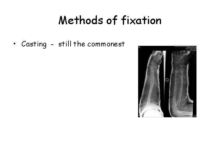 Methods of fixation • Casting - still the commonest 