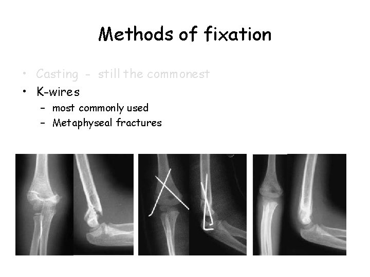 Methods of fixation • Casting - still the commonest • K-wires – most commonly