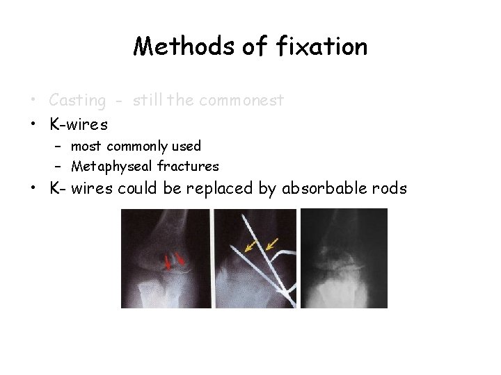 Methods of fixation • Casting - still the commonest • K-wires – most commonly