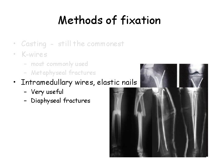 Methods of fixation • Casting - still the commonest • K-wires – most commonly