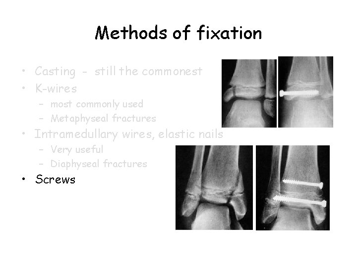 Methods of fixation • Casting - still the commonest • K-wires – most commonly