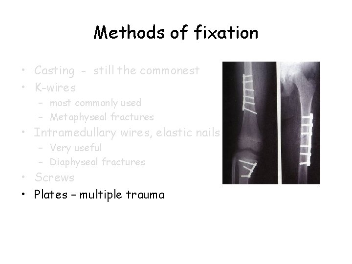 Methods of fixation • Casting - still the commonest • K-wires – most commonly