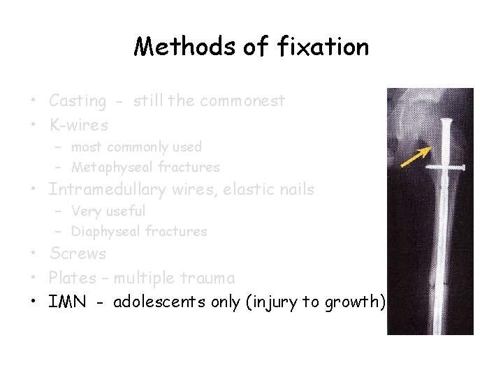 Methods of fixation • Casting - still the commonest • K-wires – most commonly