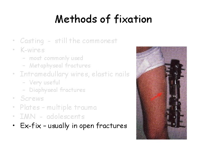 Methods of fixation • Casting - still the commonest • K-wires – most commonly