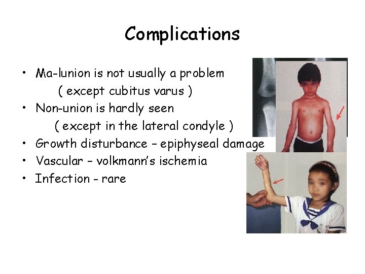 Complications • Ma-lunion is not usually a problem ( except cubitus varus ) •
