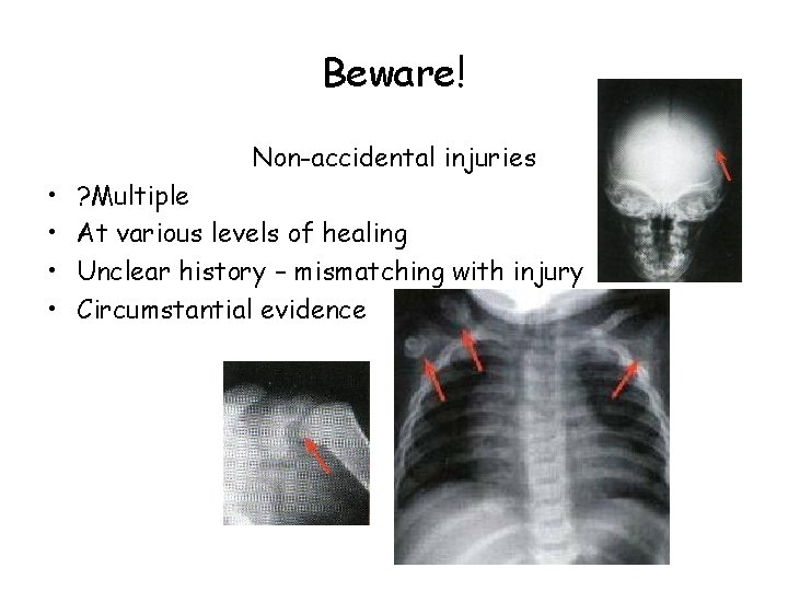 Beware! Non-accidental injuries • • ? Multiple At various levels of healing Unclear history