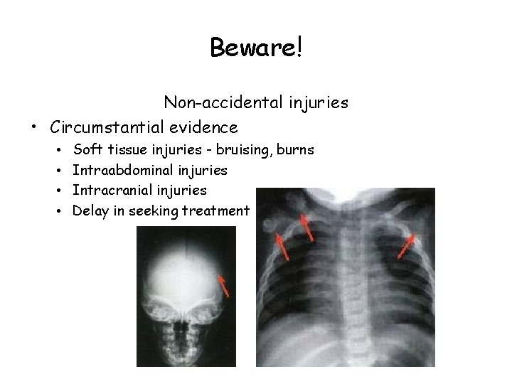 Beware! Non-accidental injuries • Circumstantial evidence • • Soft tissue injuries - bruising, burns