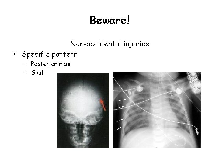 Beware! Non-accidental injuries • Specific pattern – Posterior ribs – Skull 