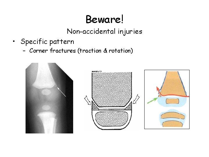 Beware! Non-accidental injuries • Specific pattern – Corner fractures (traction & rotation) 