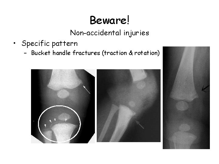 Beware! Non-accidental injuries • Specific pattern – Bucket handle fractures (traction & rotation) 