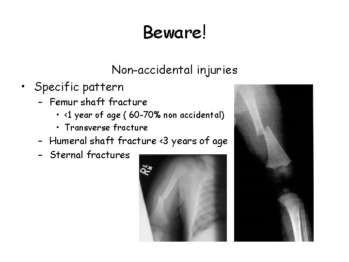 Beware! Non-accidental injuries • Specific pattern – Femur shaft fracture • <1 year of