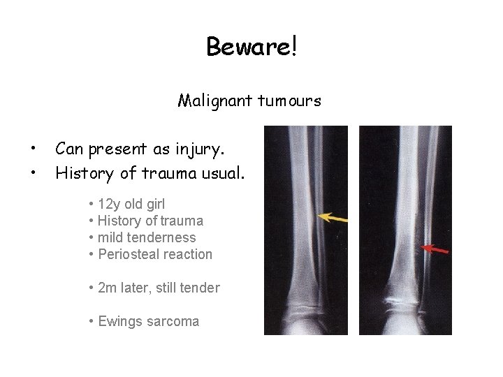 Beware! Malignant tumours • • Can present as injury. History of trauma usual. •