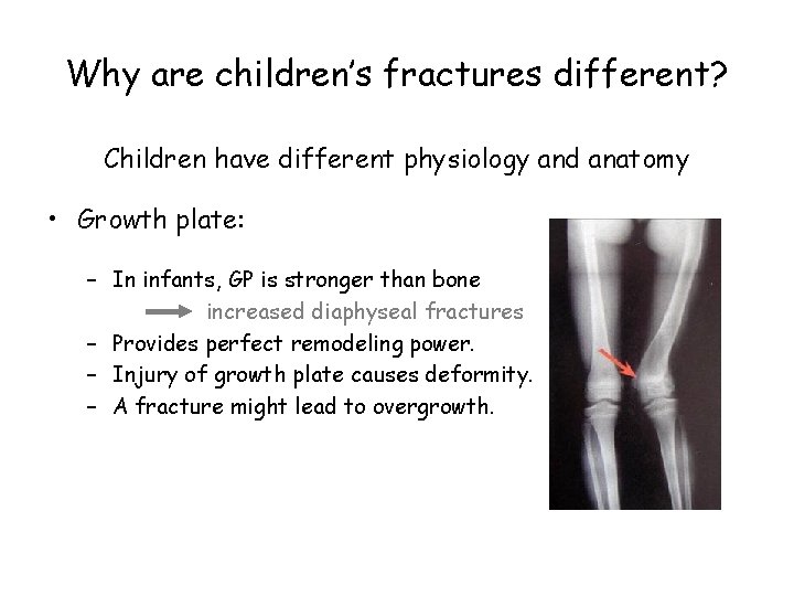 Why are children’s fractures different? Children have different physiology and anatomy • Growth plate: