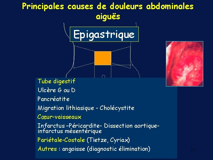 Principales causes de douleurs abdominales aiguës Epigastrique Tube digestif Ulcère G ou D Pancréatite