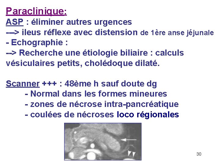 Paraclinique: ASP : éliminer autres urgences ---> ileus réflexe avec distension de 1ère anse