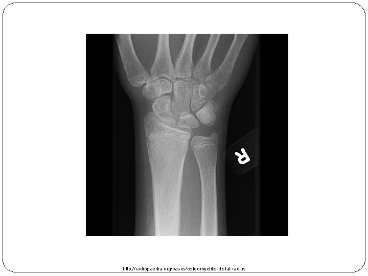 http: //radiopaedia. org/cases/osteomyelitis-distal-radius 