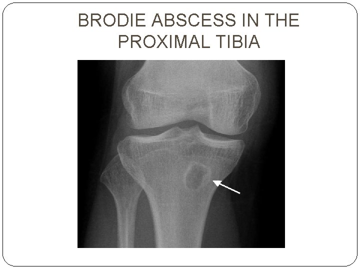 BRODIE ABSCESS IN THE PROXIMAL TIBIA 