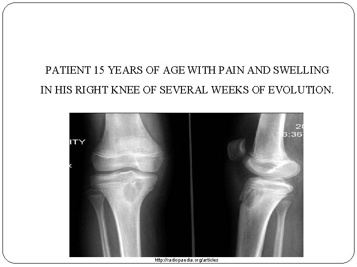 PATIENT 15 YEARS OF AGE WITH PAIN AND SWELLING IN HIS RIGHT KNEE OF