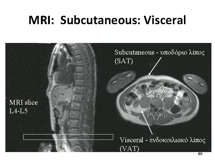 MRI: Subcutaneous: Visceral Subcutaneous - υποδόριο λίπος (SAT) MRI slice L 4 -L 5