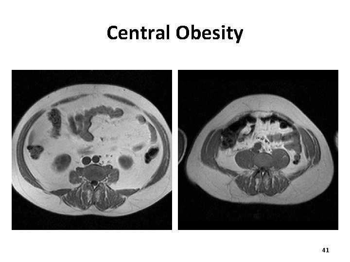 Central Obesity 41 