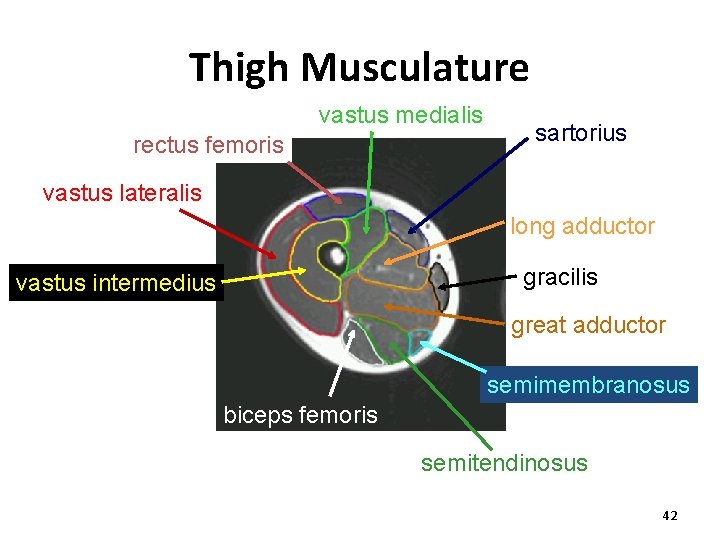 Thigh Musculature vastus medialis rectus femoris sartorius vastus lateralis long adductor gracilis vastus intermedius