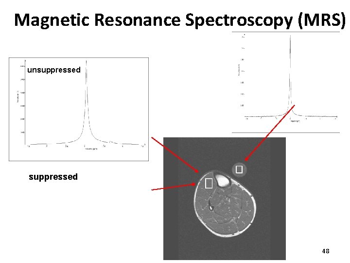 Magnetic Resonance Spectroscopy (MRS) unsuppressed 48 