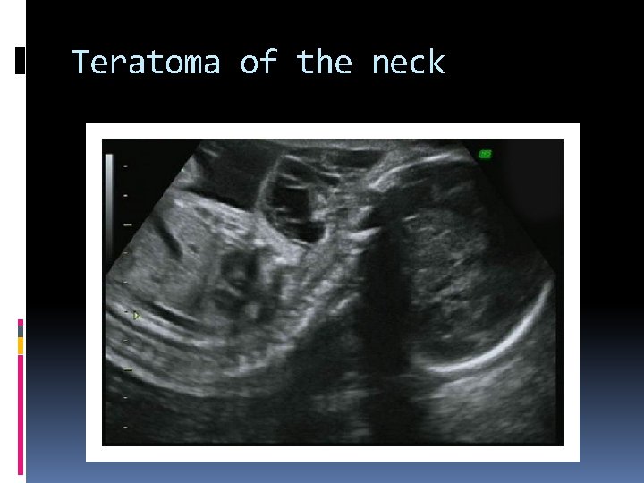 Teratoma of the neck 