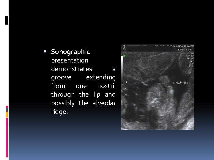  Sonographic presentation demonstrates a groove extending from one nostril through the lip and