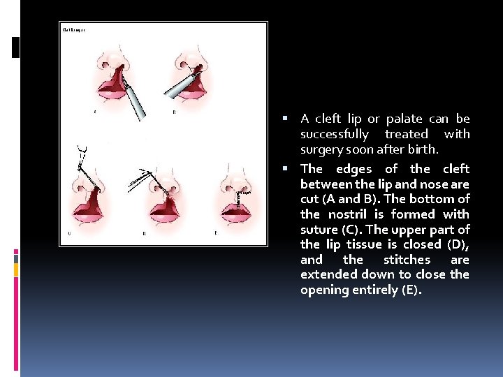  A cleft lip or palate can be successfully treated with surgery soon after