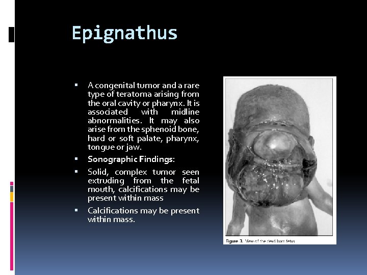 Epignathus A congenital tumor and a rare type of teratoma arising from the oral