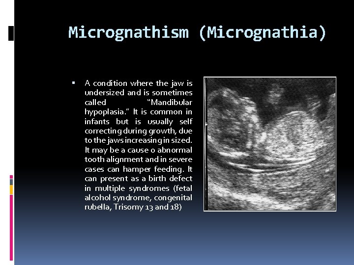 Micrognathism (Micrognathia) A condition where the jaw is undersized and is sometimes called “Mandibular
