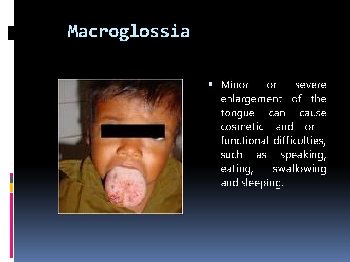 Macroglossia Minor or severe enlargement of the tongue can cause cosmetic and or functional