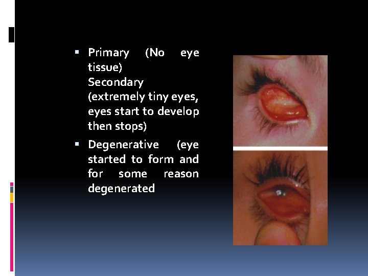  Primary (No eye tissue) Secondary (extremely tiny eyes, eyes start to develop then