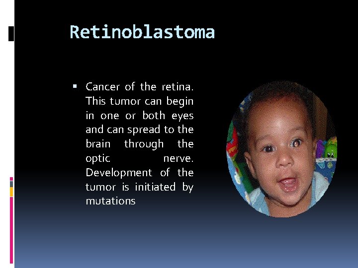 Retinoblastoma Cancer of the retina. This tumor can begin in one or both eyes