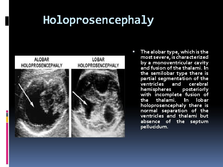 Holoprosencephaly The alobar type, which is the most severe, is characterized by a monoventricular