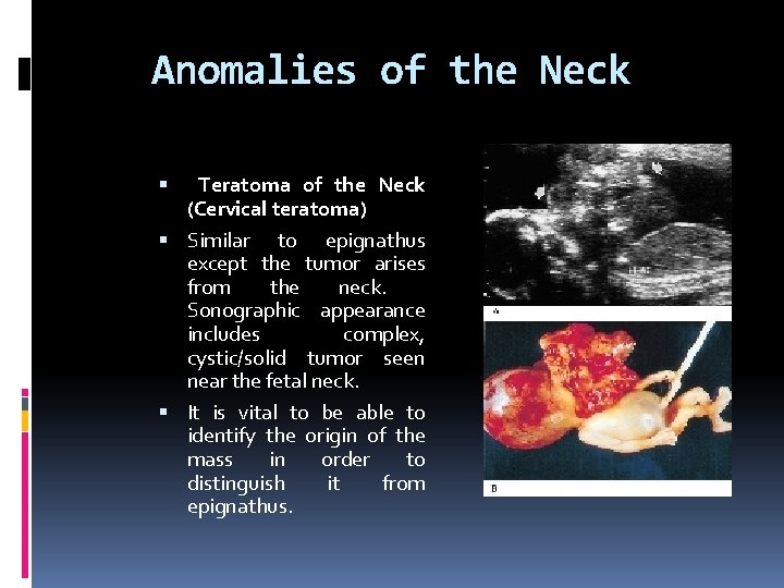 Anomalies of the Neck Teratoma of the Neck (Cervical teratoma) Similar to epignathus except