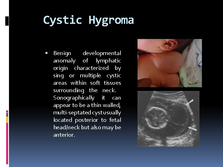 Cystic Hygroma Benign developmental anomaly of lymphatic origin characterized by sing or multiple cystic