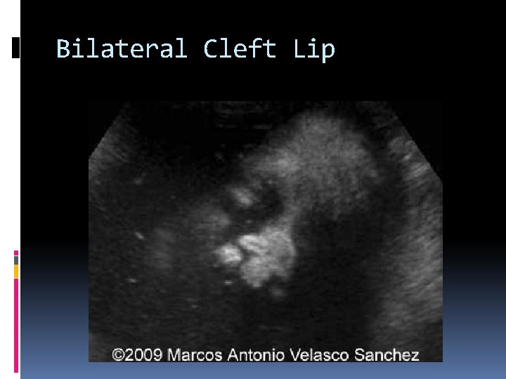 Bilateral Cleft Lip 