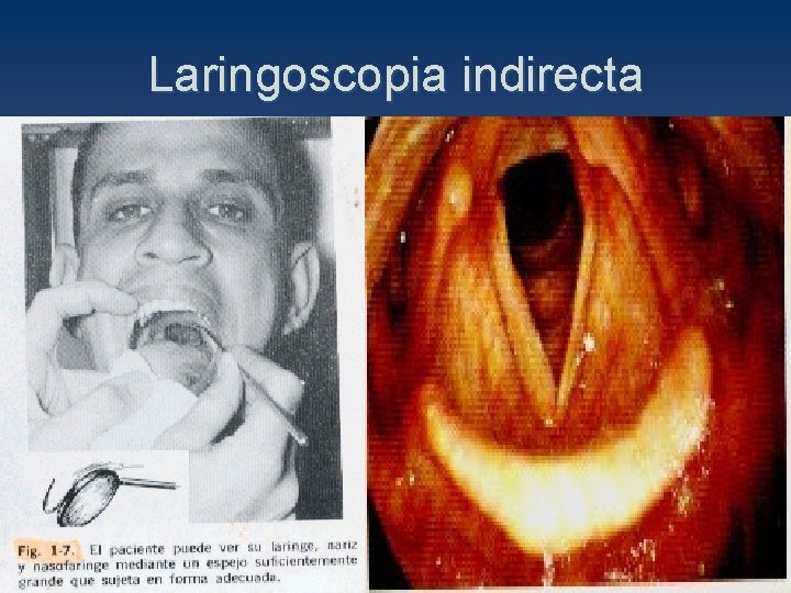 Laringoscopia indirecta 