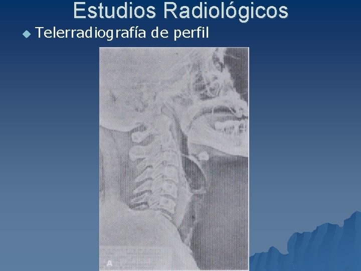 Estudios Radiológicos u Telerradiografía de perfil 