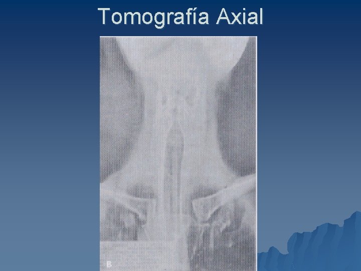 Tomografía Axial 